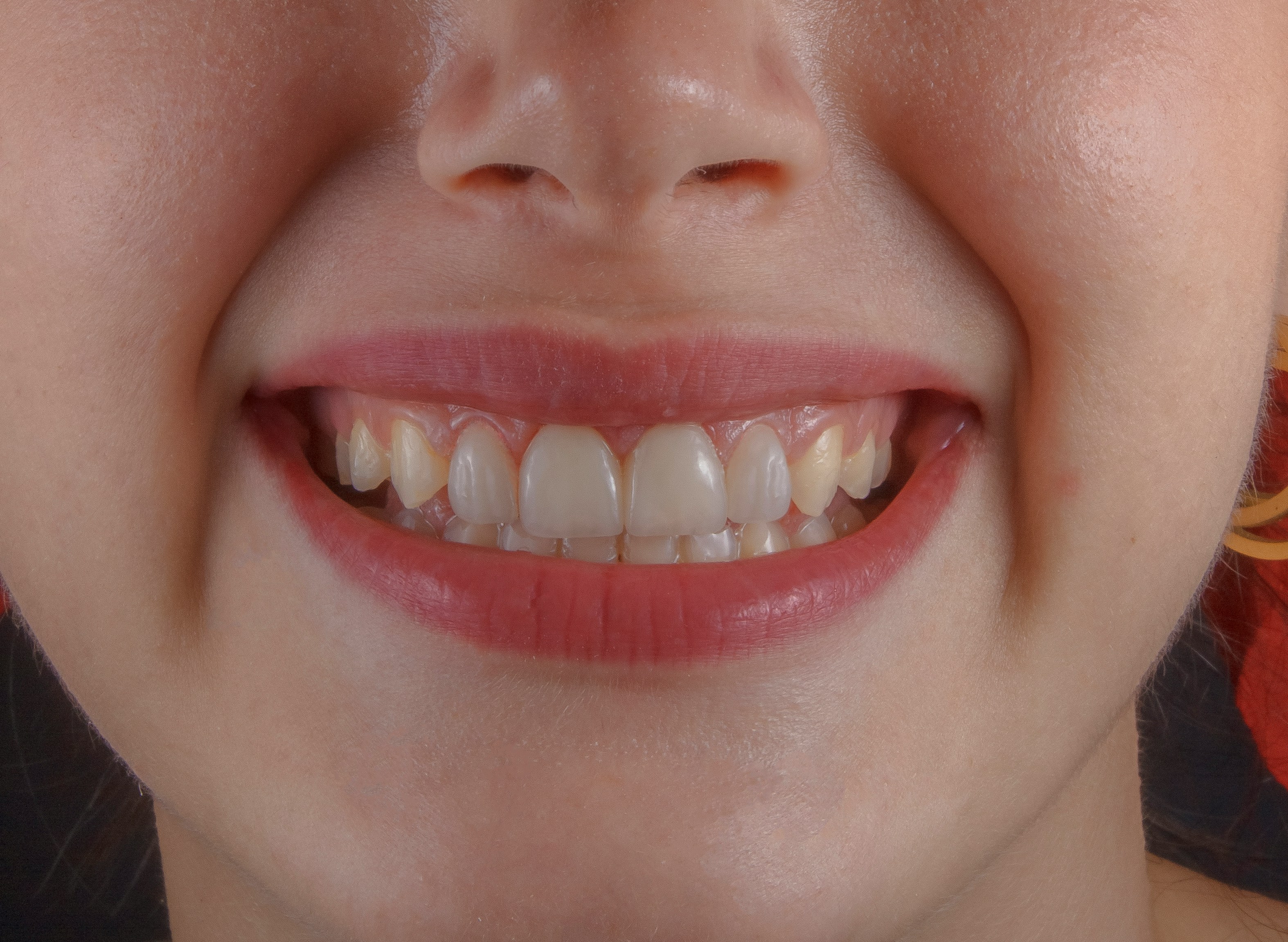 White teeth
